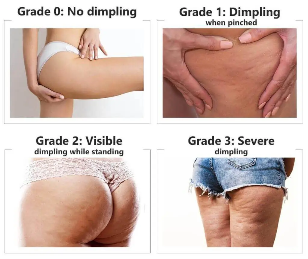 Representation of the stages of cellulite development Windsor